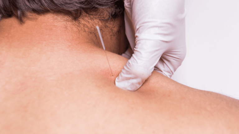 Dry needling vs. acupunctuur: Wat zijn de verschillen en overeenkomsten?